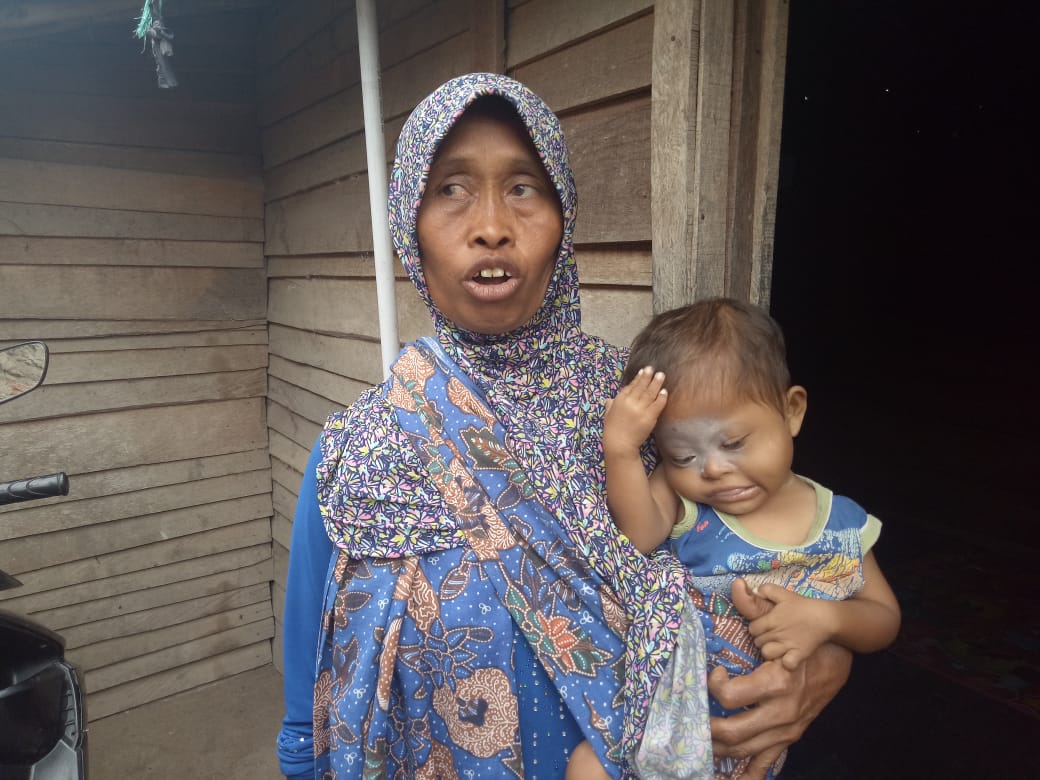 Keluarga Takut Biaya Mahal, Balita Gizi Buruk di Kota Serang Tak Ditangani Medis